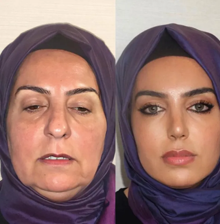 Turska klinika hvali se na Instagramu nevjerojatnim transformacijama pacijenata