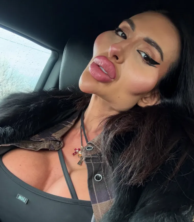 Žena s najvećim obrazima u dugotrajnom je procesu otapanja filera: Promjene su već vidljive