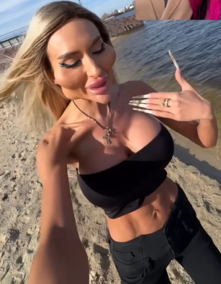 Žena s najvećim obrazima u dugotrajnom je procesu otapanja filera: Promjene su već vidljive
