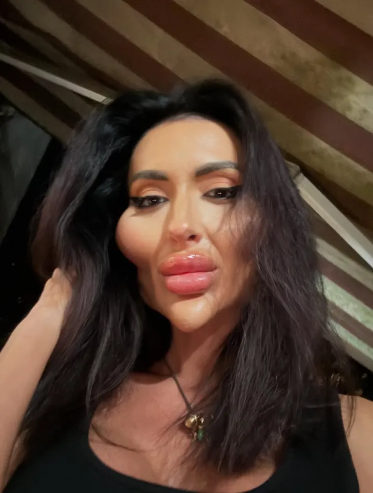 Žena s najvećim obrazima u dugotrajnom je procesu otapanja filera: Promjene su već vidljive