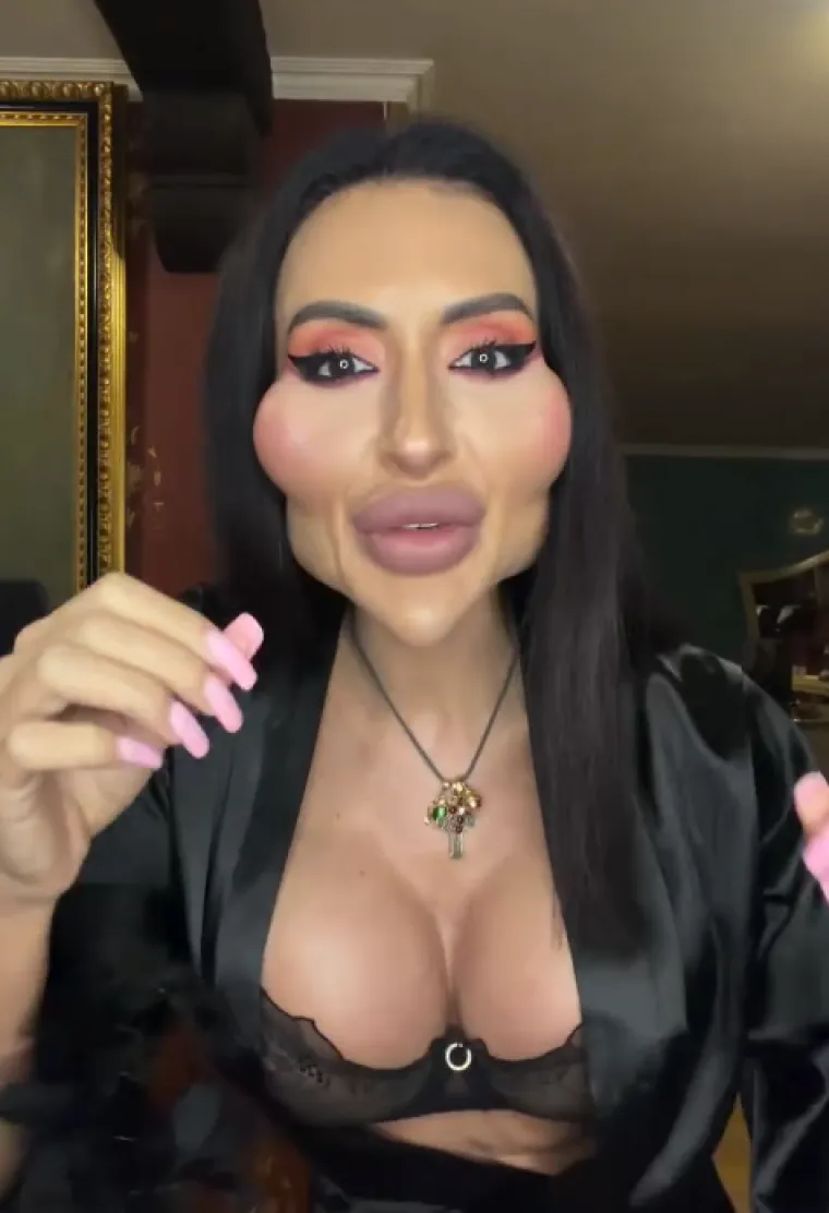 Žena s najvećim obrazima u dugotrajnom je procesu otapanja filera: Promjene su već vidljive