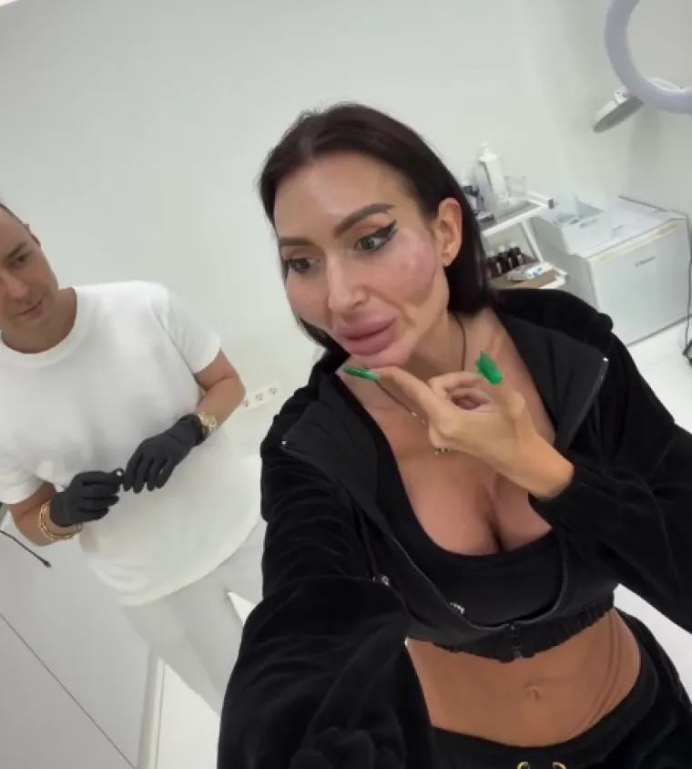 Žena s najvećim obrazima u dugotrajnom je procesu otapanja filera: Promjene su već vidljive
