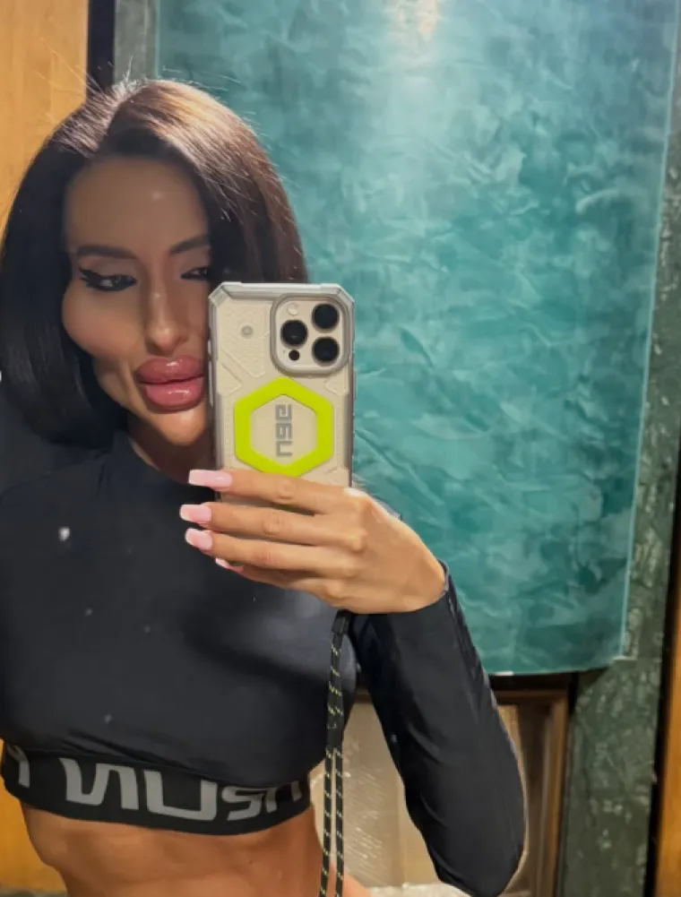 Žena s najvećim obrazima u dugotrajnom je procesu otapanja filera: Promjene su već vidljive