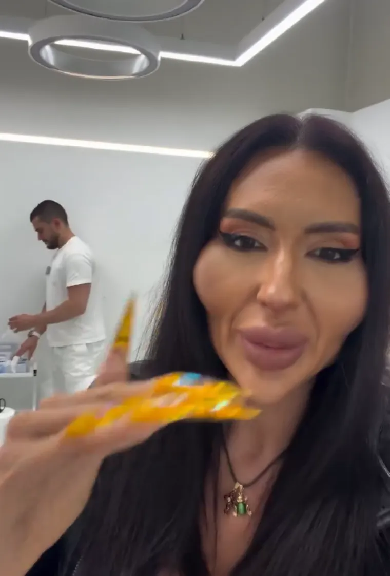 Žena s najvećim obrazima u dugotrajnom je procesu otapanja filera: Promjene su već vidljive