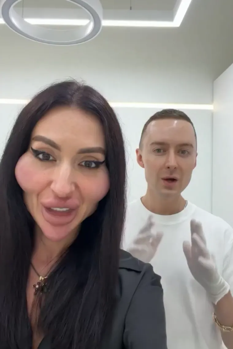 Žena s najvećim obrazima u dugotrajnom je procesu otapanja filera: Promjene su već vidljive