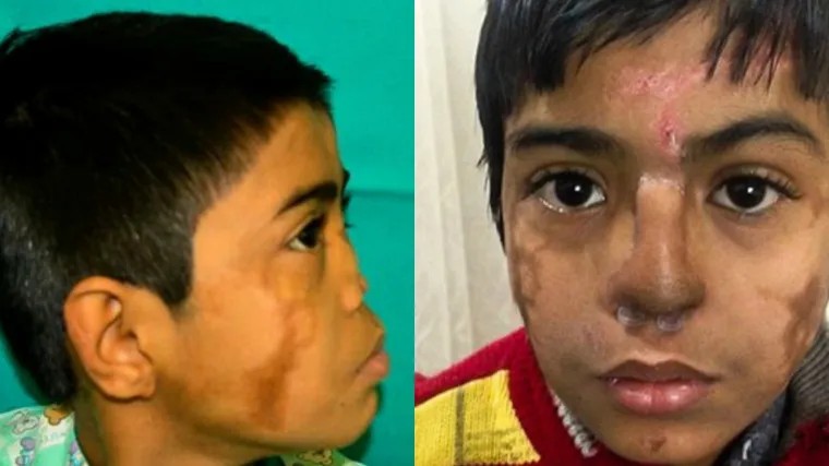 Rijetka plastična operacija: indijski liječnici uzgojili novi nos na dječakovu čelu