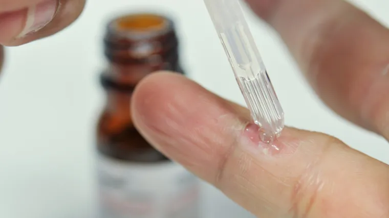 Virusne bradavice mogu se izliječiti sokom ovih biljaka, a rezultati su jako brzo vidljivi