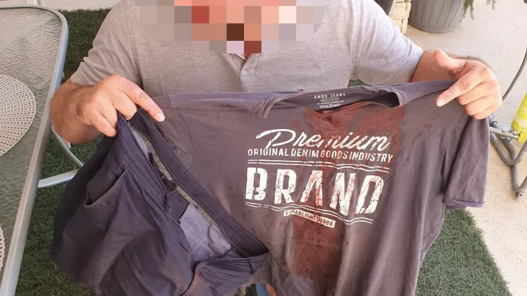 FOTO Napad na Pagu: 'Došli su na terasu apartmana i teleskopskom palicom su mi razbili glavu'