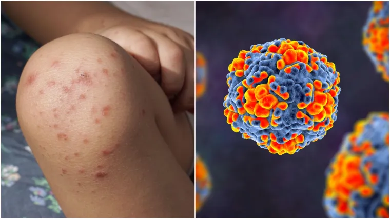 Jako zarazan virus hara među djecom u Srbiji: 'Ako vidite ove simptome odmah idite liječniku'