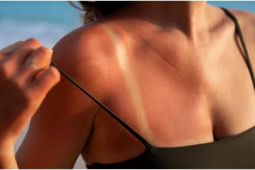 Simptomi raka kože mogu se razviti nakon 15 minuta na suncu: Pripazite na ove znakove