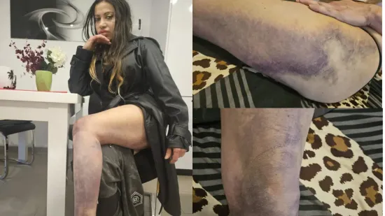 Super Silva o brutalnom napadu bejzbol palicama: 'I dalje mi prijete, bojim se za svoj život'