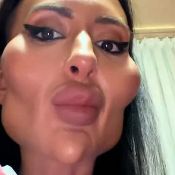 Žena je s najvećim obrazima na svijetu