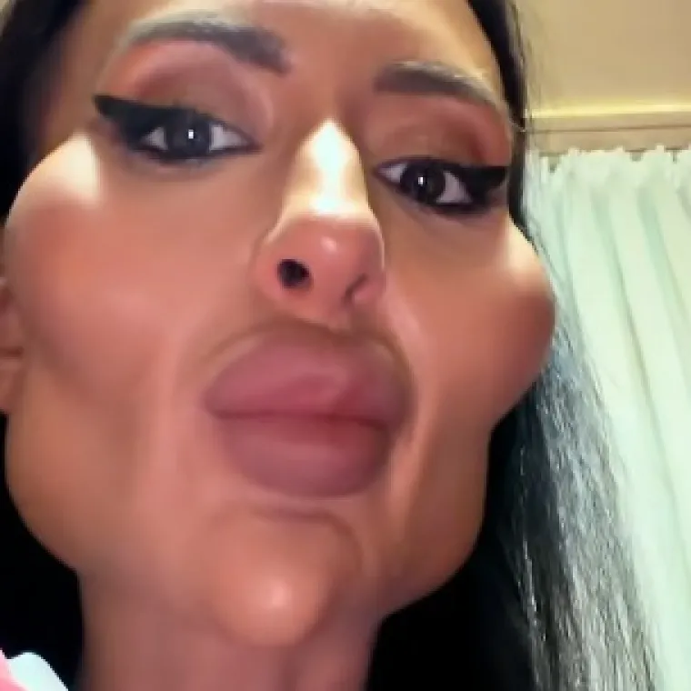 Žena je s najvećim obrazima na svijetu