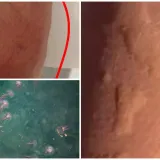 Popodnevno kupanje kraj Splita pretvorio se u bolnu agoniju: 'Peklo nas je cijelo tijelo'