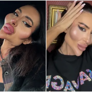 Žena s najvećim obrazima u dugotrajnom je procesu otapanja filera: Promjene su već vidljive