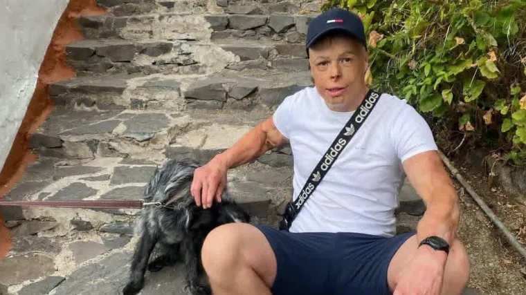 Tijelom mu pro&scaron;lo 11.000 volti, klinički je umro na 14 minuta: 'Udar me rastrgao'
