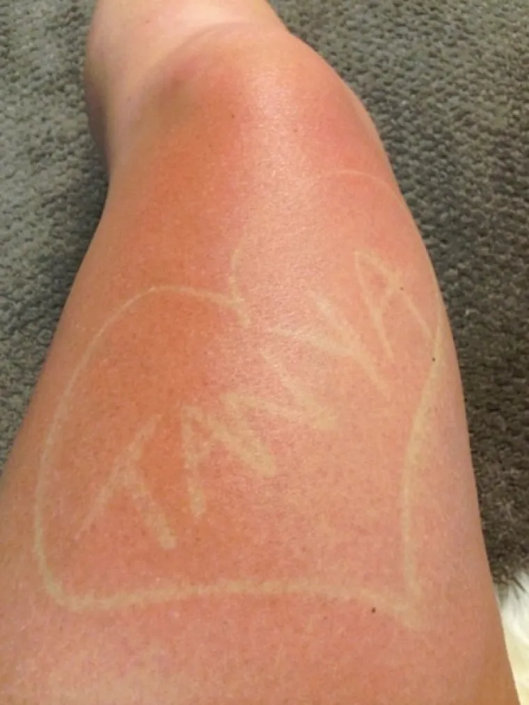 Vjerovali ili ne, neki ljudi se namjerno 'spaljuju' suncem kako bi si napravili 'prirodne tetovaže'. Ah, ti trendovi...