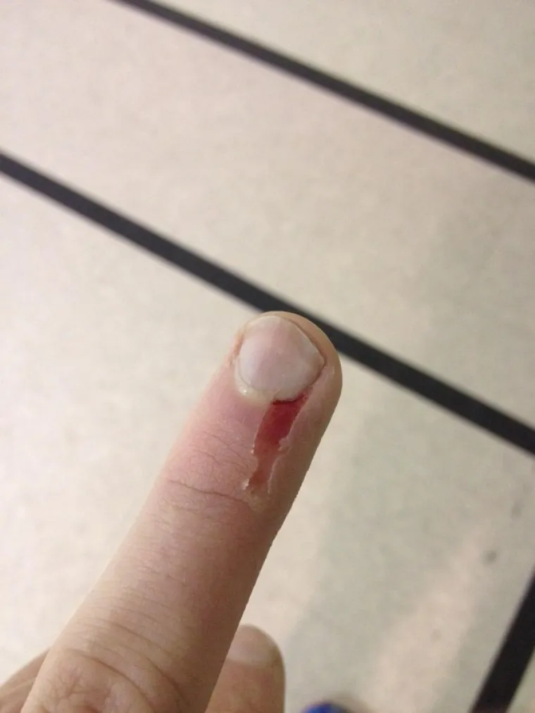 Gadljivost je vrlo subjektivna, ali ako uspijete pogledati galeriju do kraja i ostati pri svijesti, vjerojatno niste nimalo gadljivi. Upozorili smo vas, a na vama je da testirate svoju gadljivost ako mislite da ste dovoljno otporni.