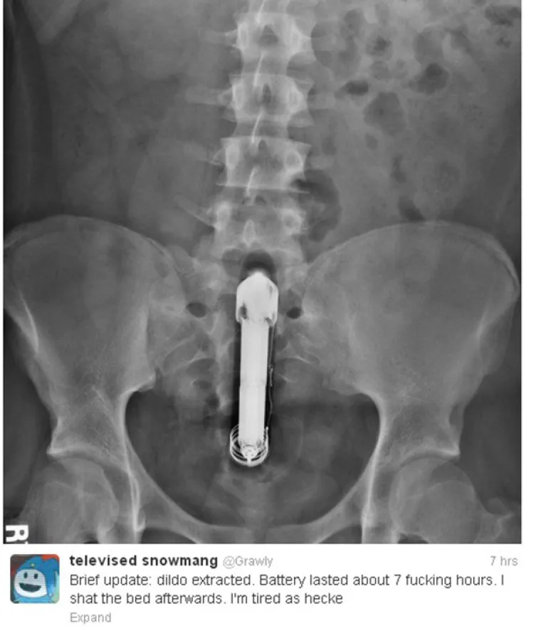 Zapeo mu vibrator u guzi, a on svoje iskustvo tweetao cijelom internetu. Za znanost...