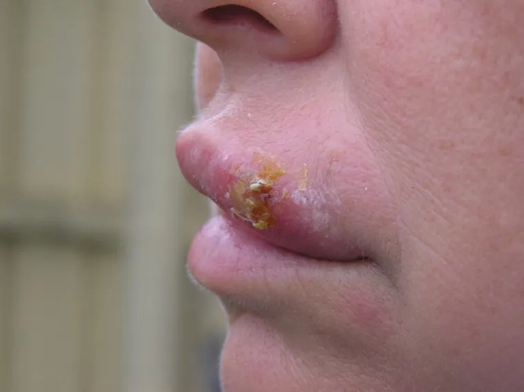 9. Vjerovali ili ne, od ove ružne navike možete čak dobiti herpes.