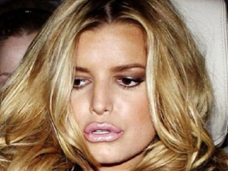 Kad se poznati unakaze plastičnim operacijama, rezultati mogu biti zastra&scaron;ujući