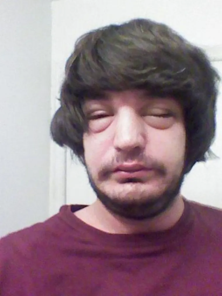 POTPUNA PREOBRAZBA: Jadničci koje je ubod pčele totalno izobličio