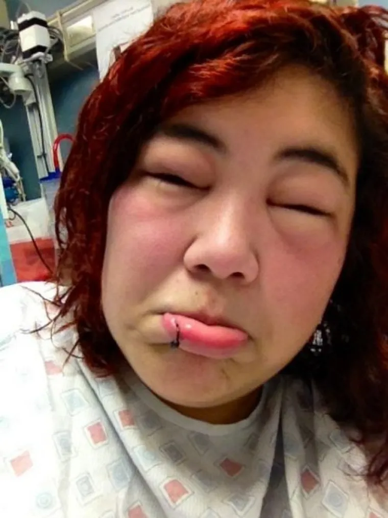 POTPUNA PREOBRAZBA: Jadničci koje je ubod pčele totalno izobličio