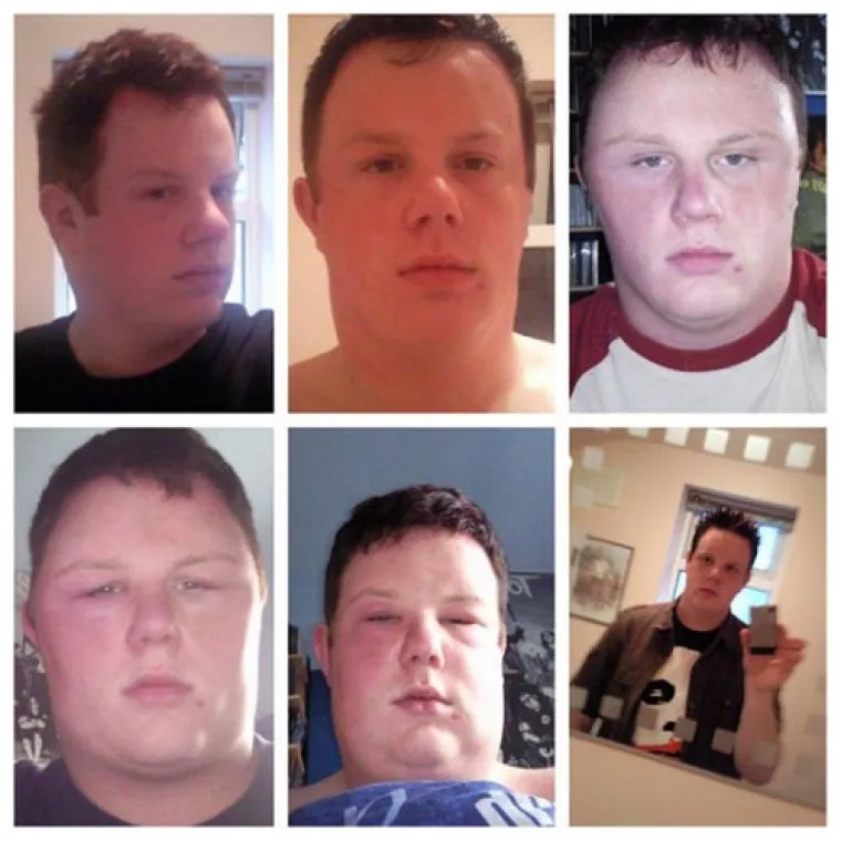 POTPUNA PREOBRAZBA: Jadničci koje je ubod pčele totalno izobličio