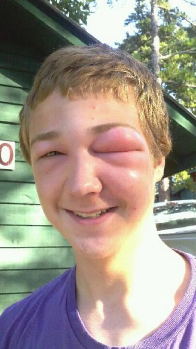 POTPUNA PREOBRAZBA: Jadničci koje je ubod pčele totalno izobličio