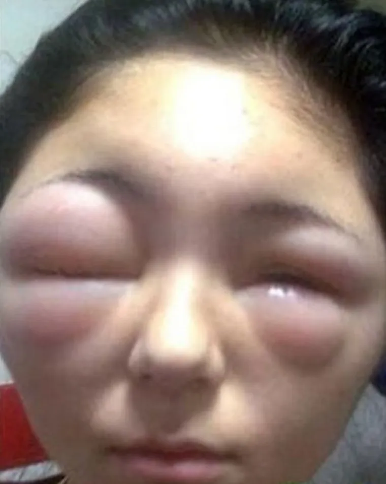 POTPUNA PREOBRAZBA: Jadničci koje je ubod pčele totalno izobličio