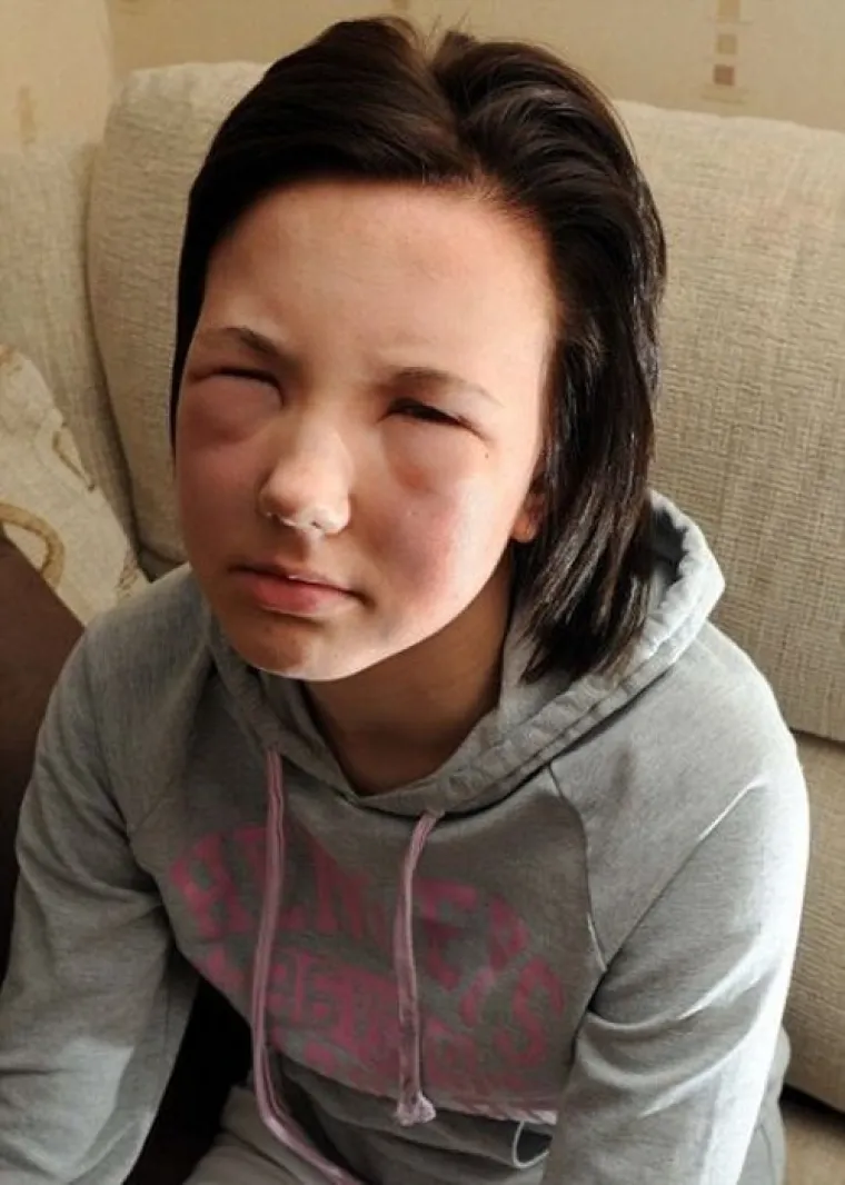 POTPUNA PREOBRAZBA: Jadničci koje je ubod pčele totalno izobličio