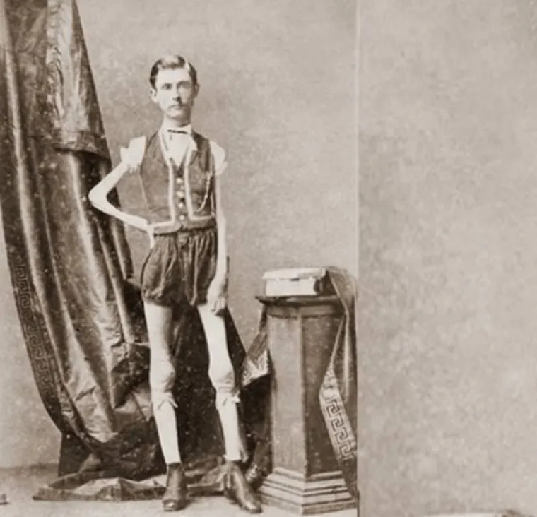 Isaac W. Sprague bio je poznat kao Živući kostur. Rođen je 1841. kao relativno zdravo dijete, no s 12 godina je jednostavno počeo kopnjeti. Doživio je 44. godinu iako je većinu života imao samo 20 kilograma. Dva puta de ženio i imao je troje djece, od kojih niti jedno nije naslijedilo njegovu bolest.