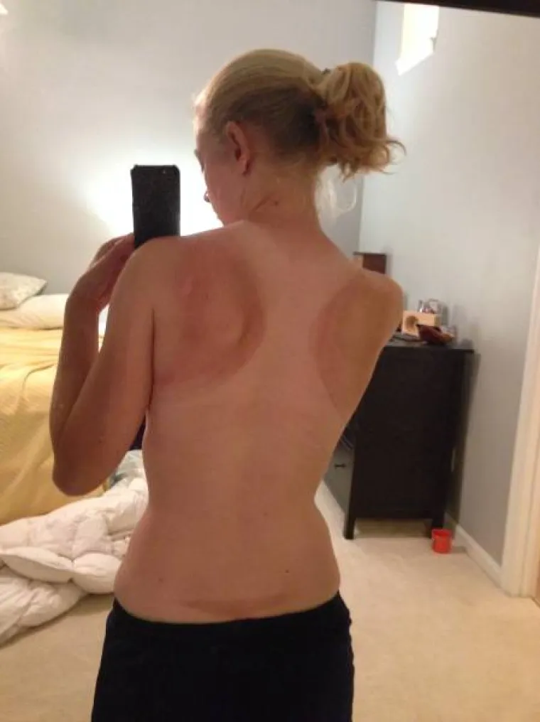 Izgleda da svake sezone ljude treba iznova podsjećati da se prije sunčanja treba mazati kremama za sunčanje. Unatoč tome &scaron;to se to uvijek iznova ponavlja, postoje ljudi koji naprosto nikada ne nauče lekciju. U galeriji smo okupili neke od njih.