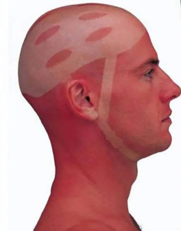 'MA, NE TREBA MENI KREMA ZA SUNČANJE': Evo kako zavr&scaron;e ljudi koji misle da su pametniji od Sunca