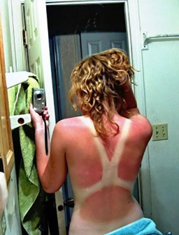 'MA, NE TREBA MENI KREMA ZA SUNČANJE': Evo kako zavr&scaron;e ljudi koji misle da su pametniji od Sunca