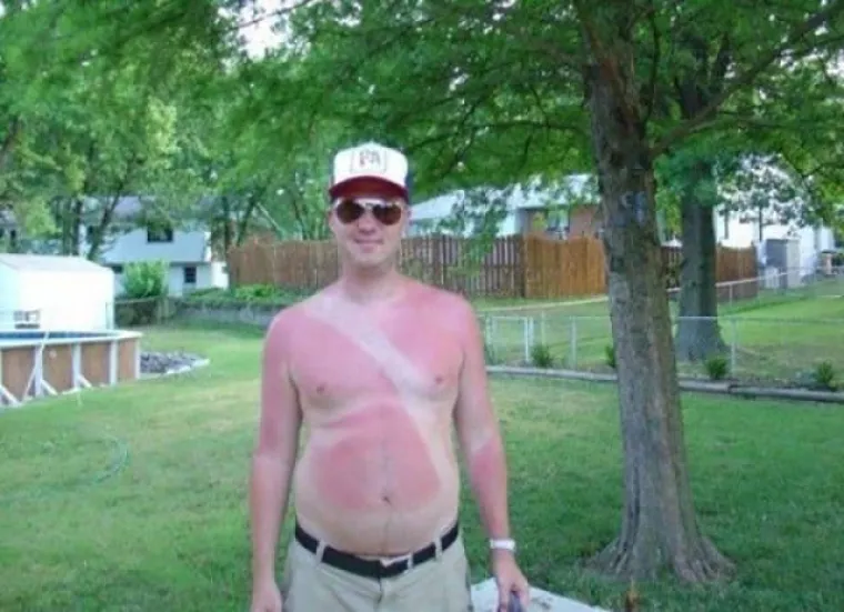 'MA, NE TREBA MENI KREMA ZA SUNČANJE': Evo kako zavr&scaron;e ljudi koji misle da su pametniji od Sunca