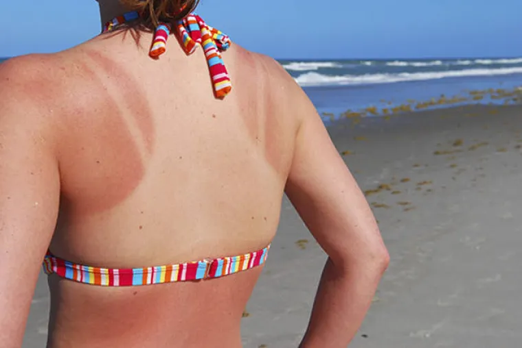 'MA, NE TREBA MENI KREMA ZA SUNČANJE': Evo kako zavr&scaron;e ljudi koji misle da su pametniji od Sunca