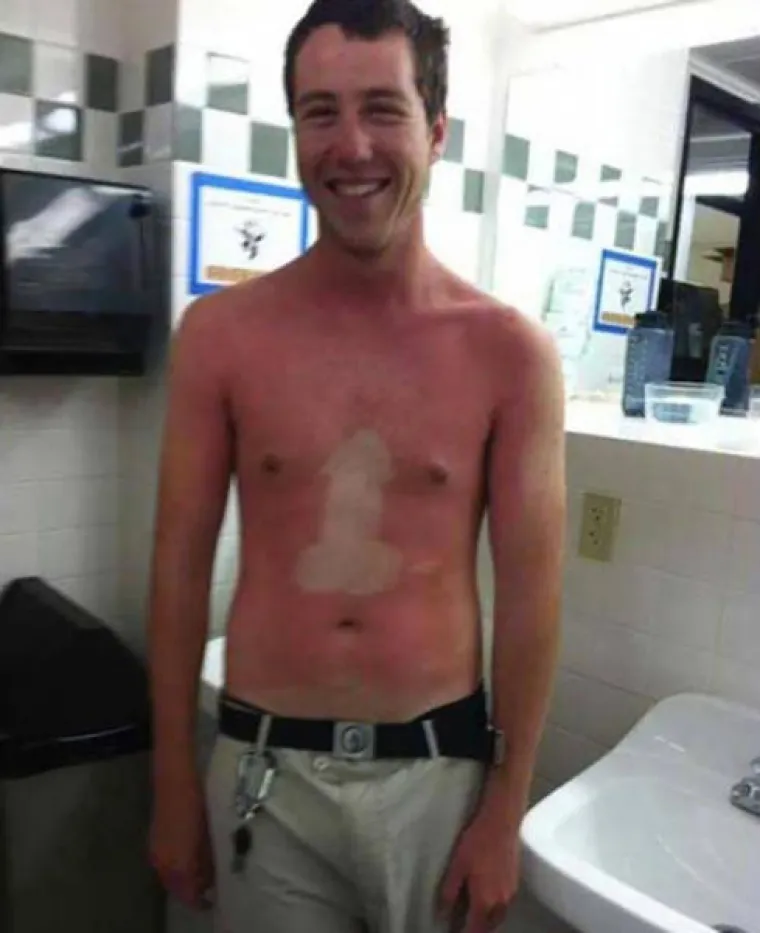 'MA, NE TREBA MENI KREMA ZA SUNČANJE': Evo kako zavr&scaron;e ljudi koji misle da su pametniji od Sunca