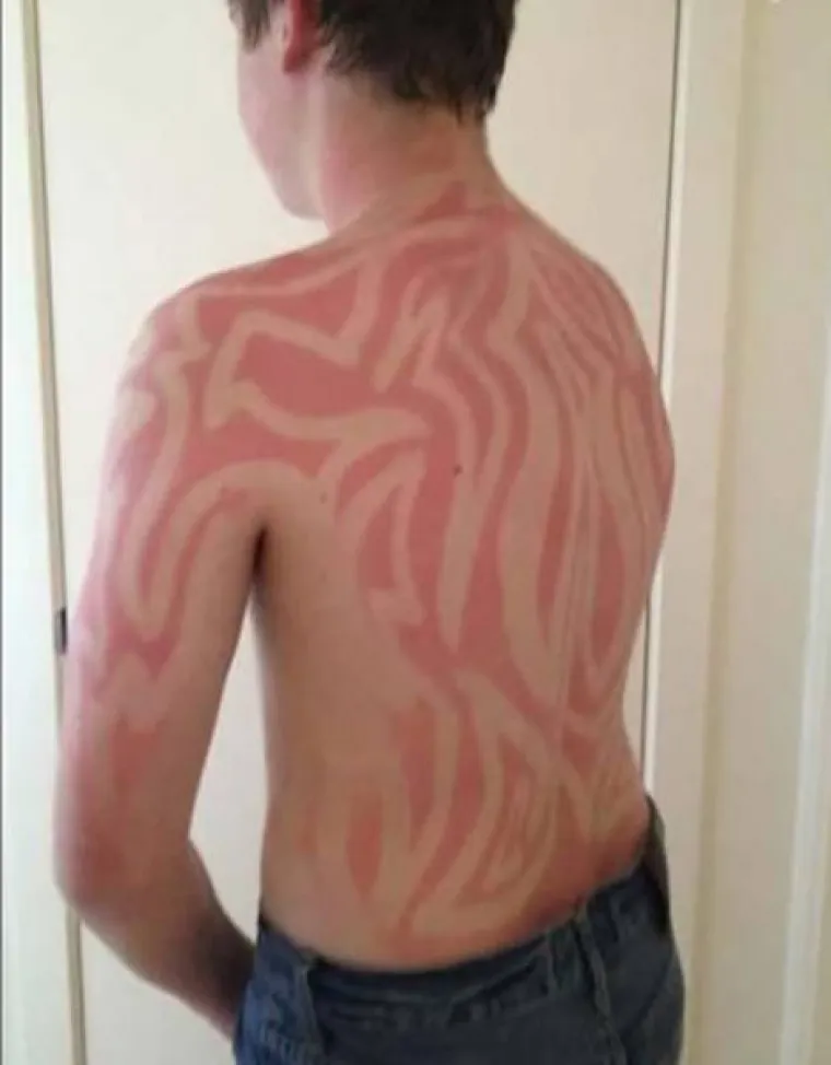 'MA, NE TREBA MENI KREMA ZA SUNČANJE': Evo kako zavr&scaron;e ljudi koji misle da su pametniji od Sunca