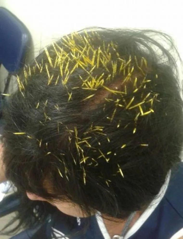 Kolike su &scaron;anse da vam dikobraz padne na glavu?