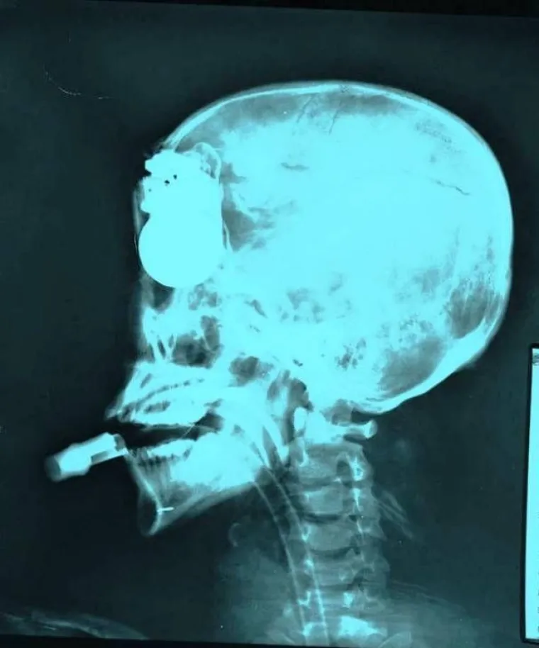 Nije nam jasno je li dobro vidimo, jo&scaron; manje kako je tako ne&scaron;to moguće, ali ovaj lik ima ručnu granatu zakačenu u glavi