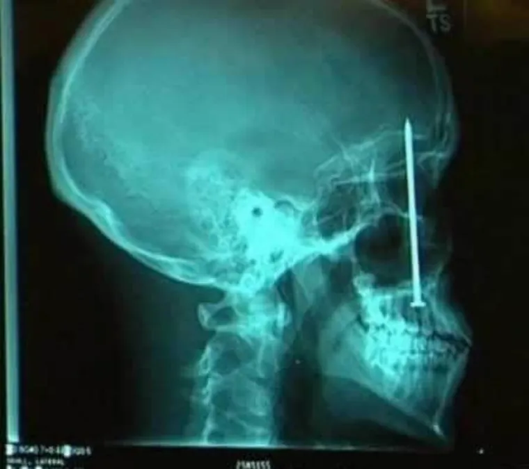 Do&scaron;ao je zubaru žaleći se na zubobolju