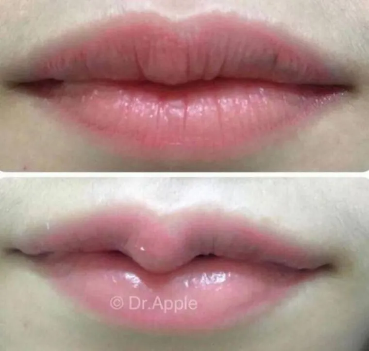 OPERIRAJU SE DO URNEBESA: Novi trend među plastičnim operacijama je stvarno nebulozan