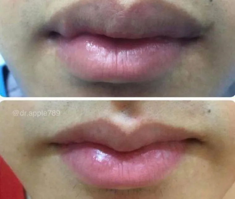OPERIRAJU SE DO URNEBESA: Novi trend među plastičnim operacijama je stvarno nebulozan
