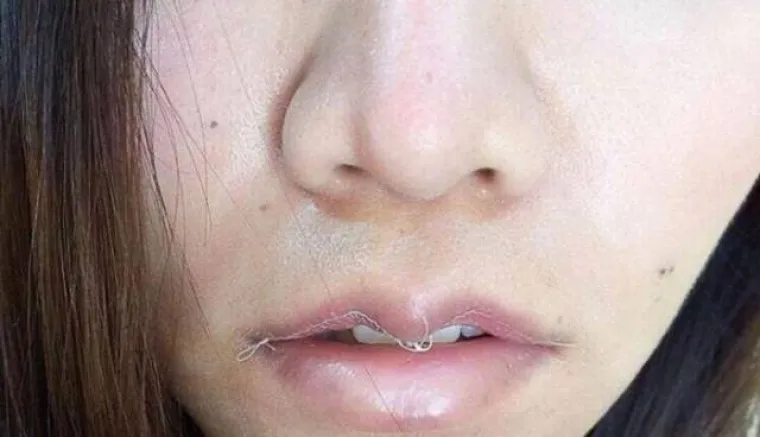 OPERIRAJU SE DO URNEBESA: Novi trend među plastičnim operacijama je stvarno nebulozan