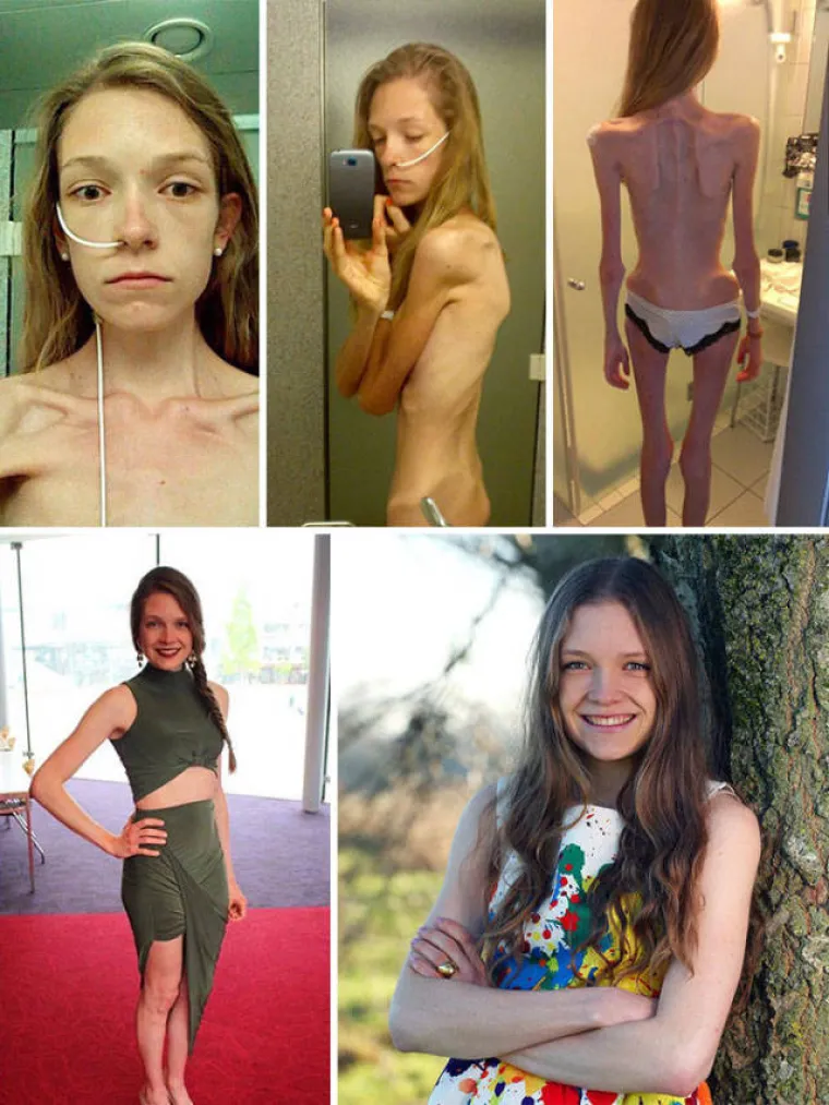 SABLASNE POSLJEDICE ANOREKSIJE: Objavili fotografije snimljene prije i nakon oporavka, rezultati su stvarno impresivni