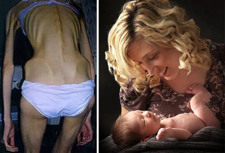 SABLASNE POSLJEDICE ANOREKSIJE: Objavili fotografije snimljene prije i nakon oporavka, rezultati su stvarno impresivni