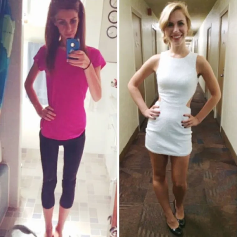 SABLASNE POSLJEDICE ANOREKSIJE: Objavili fotografije snimljene prije i nakon oporavka, rezultati su stvarno impresivni