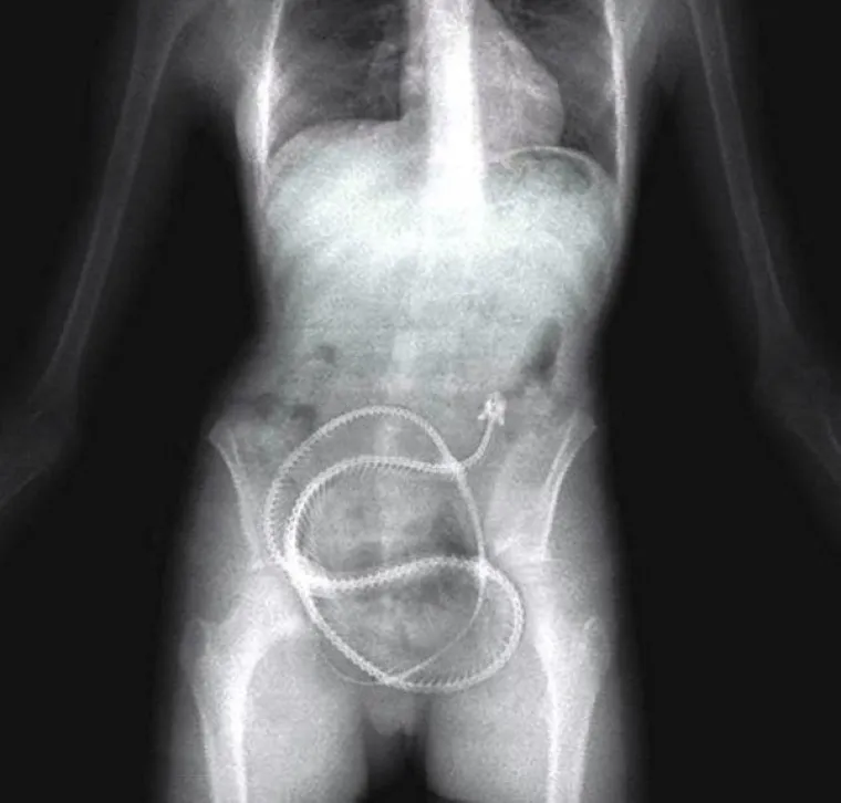 LJUDI SU ČAROBNO SPREMI&Scaron;TE, U NJIH STANE BA&Scaron; SVE: Nevjerojatne snimke pokazuju &scaron;to su sve uspjeli ugurati u sebe