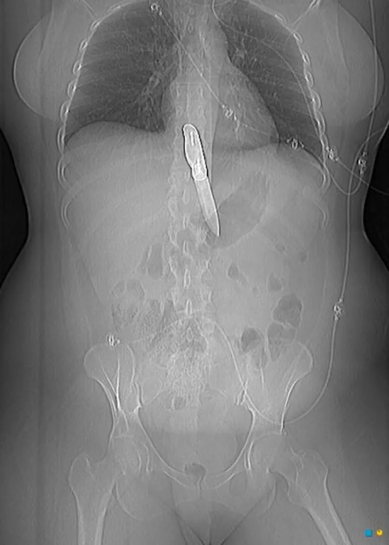 LJUDI SU ČAROBNO SPREMI&Scaron;TE, U NJIH STANE BA&Scaron; SVE: Nevjerojatne snimke pokazuju &scaron;to su sve uspjeli ugurati u sebe